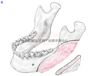 下顎骨角:下顎骨削骨手術4
