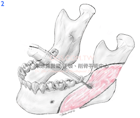 下顎骨角:下顎骨削骨手術2