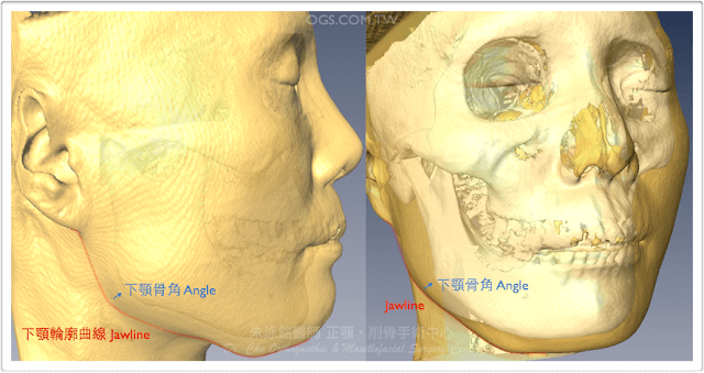 下顎骨透視-下顎削骨