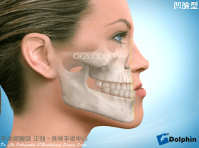 凹臉型-正顎手術