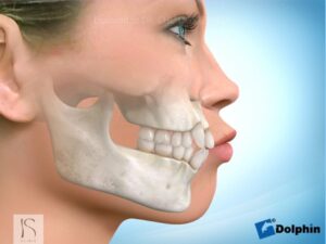正顎手術-暴牙-雙顎突出