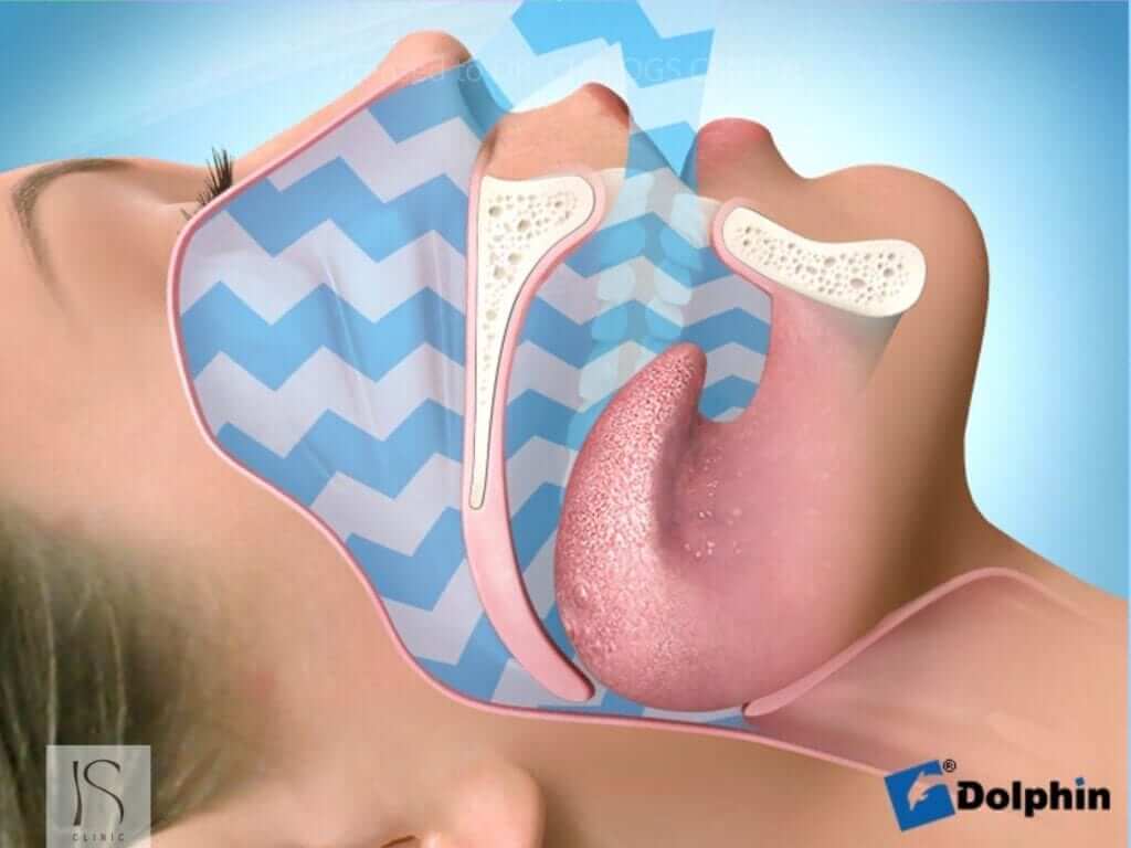 正顎手術-睡眠呼吸中止症