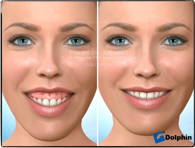 笑齦-長臉-正顎手術