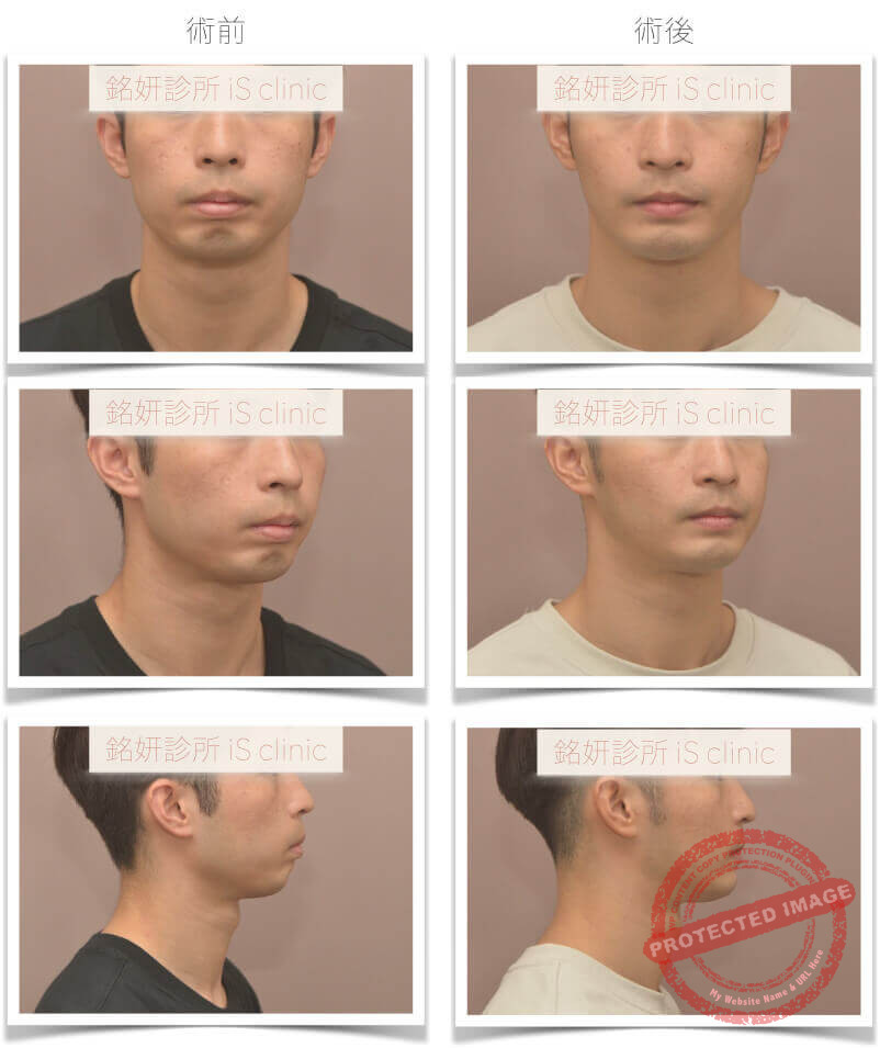 下顎後縮 正顎手術 朱泳銘醫師正顎手術及削骨手術中心