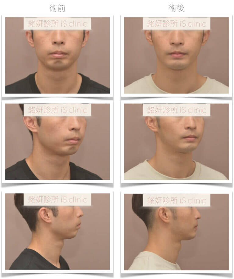 下顎後縮-臉不對稱-進階正顎手術-正顎手術