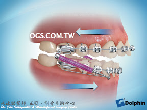 暴牙矯正-功能性矯正器