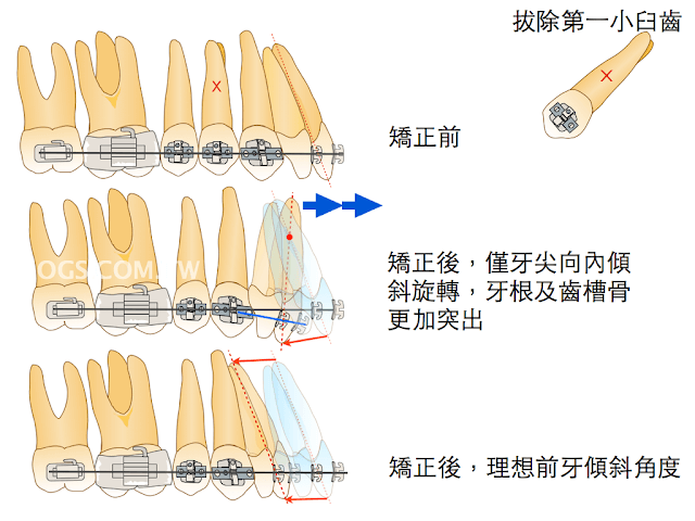 暴牙矯正-骨性暴牙錨點控制