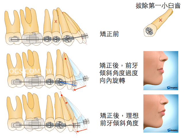 暴牙矯正-齒性暴牙錨點控制