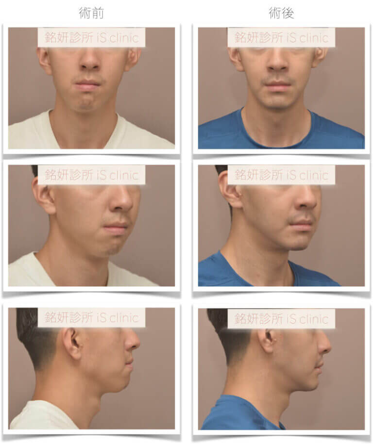 臉不對稱-不典型戽斗-進階手術優先-正顎手術